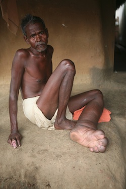 Lymphatic filariasis patient with visible enlargement of left foot, India. Photo: World Health Organization